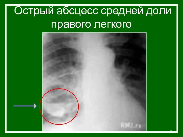 Острый абсцесс средней доли правого легкого