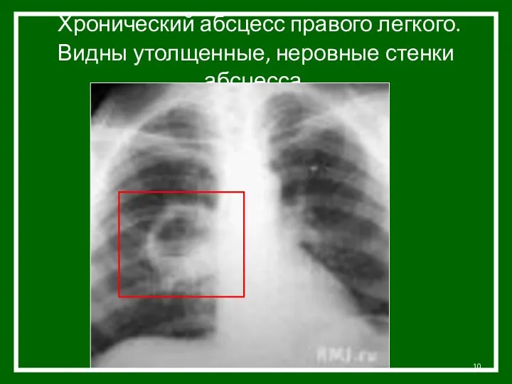 Хронический абсцесс правого легкого. Видны утолщенные, неровные стенки абсцесса.