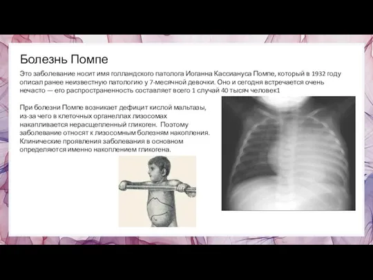 Болезнь Помпе Это заболевание носит имя голландского патолога Иоганна Кассиануса Помпе,