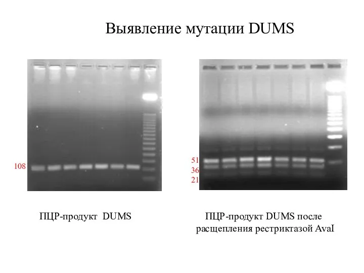 51 36 21 108 ПЦР-продукт DUMS ПЦР-продукт DUMS после расщепления рестриктазой AvaI Выявление мутации DUMS