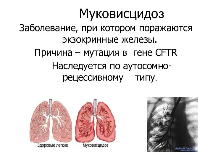 Муковисцидоз Заболевание, при котором поражаются экзокринные железы. Причина – мутация в