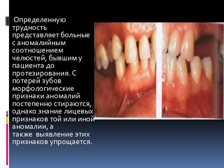 Определенную трудность представляет больные с аномалийным соотношением челюстей, бывшим у пациента