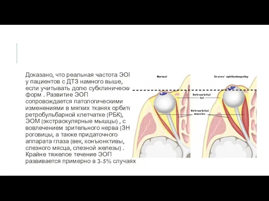 Доказано, что реальная частота ЭОП у пациентов с ДТЗ намного выше,