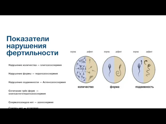 Показатели нарушения фертильности Нарушение количества — олигозооспермия Нарушение формы — тератозооспермия