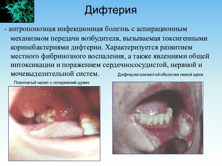 Дифтерия - антропонозная инфекционная болезнь с аспирационным механизмом передачи возбудителя, вызываемая