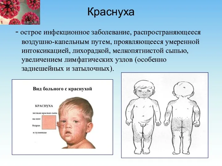 Краснуха - острое инфекционное заболевание, распространяющееся воздушно-капельным путем, проявляющееся умеренной интоксикацией,