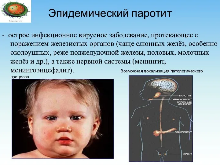 Эпидемический паротит - острое инфекционное вирусное заболевание, протекающее с поражением железистых