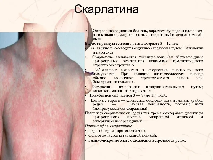 Скарлатина Острая инфекционная болезнь, характеризующаяся наличием интоксикации, острого тонзиллита (ангины) и