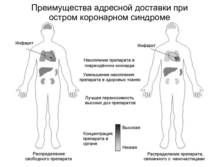 Преимущества адресной доставки при остром коронарном синдроме