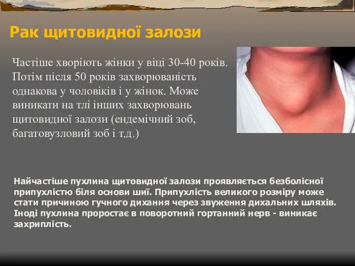 Рак щитовидної залози Частіше хворіють жінки у віці 30-40 років. Потім