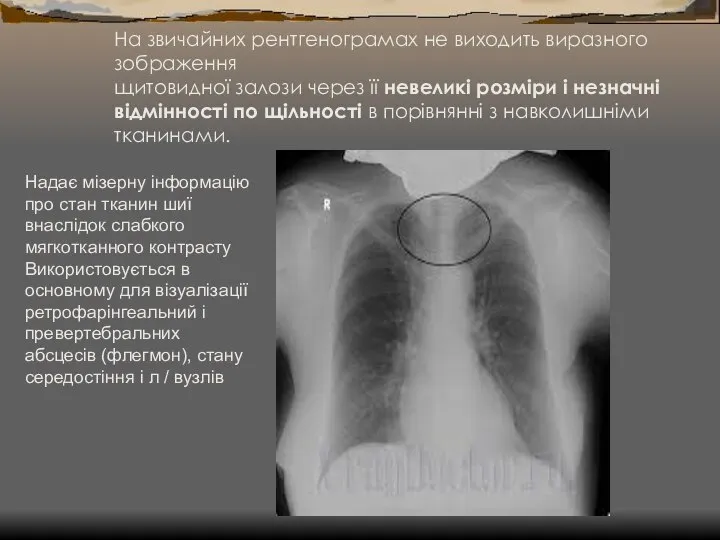 На звичайних рентгенограмах не виходить виразного зображення щитовидної залози через її