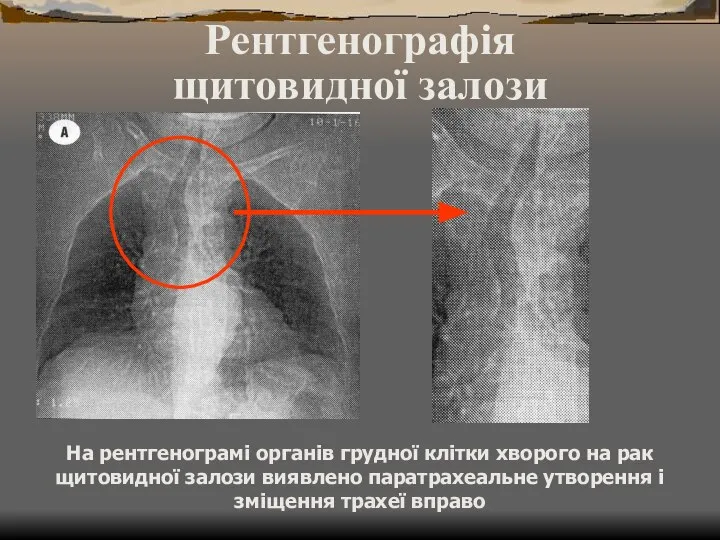 Рентгенографія щитовидної залози На рентгенограмі органів грудної клітки хворого на рак