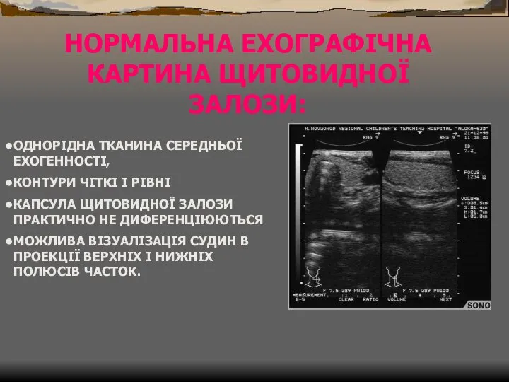 НОРМАЛЬНА ЕХОГРАФІЧНА КАРТИНА ЩИТОВИДНОЇ ЗАЛОЗИ: ОДНОРІДНА ТКАНИНА СЕРЕДНЬОЇ ЕХОГЕННОСТІ, КОНТУРИ ЧІТКІ