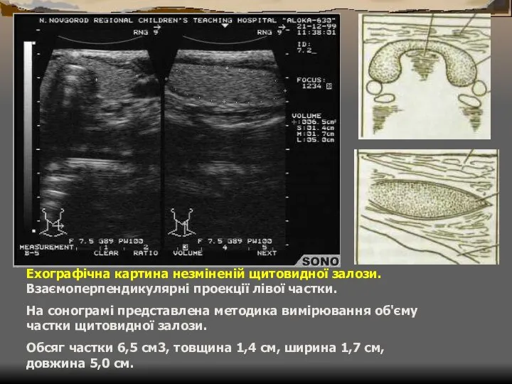 Ехографічна картина незміненій щитовидної залози. Взаємоперпендикулярні проекції лівої частки. На сонограмі