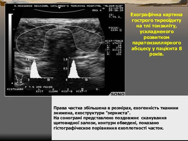 Ехографічна картина гострого тиреоїдиту на тлі тонзиліту, ускладненого розвитком паратонзиллярного абсцесу у пацієнта 8 років.