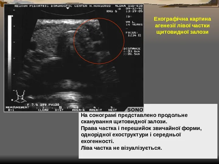 На сонограмі представлено продольне сканування щитовидної залози. Права частка і перешийок