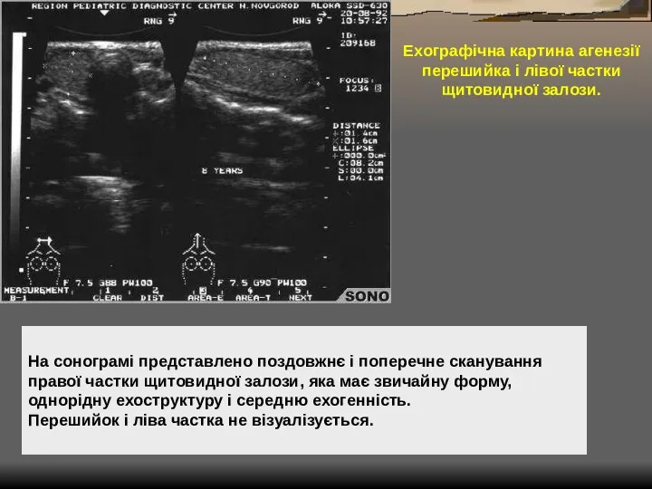 На сонограмі представлено поздовжнє і поперечне сканування правої частки щитовидної залози,