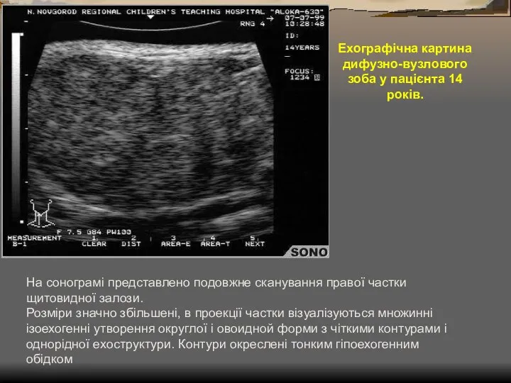 На сонограмі представлено подовжне сканування правої частки щитовидної залози. Розміри значно