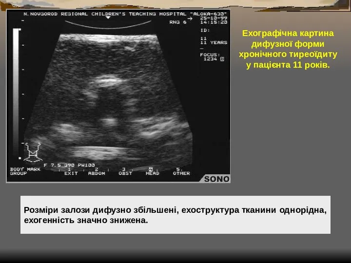 Ехографічна картина дифузної форми хронічного тиреоїдиту у пацієнта 11 років.