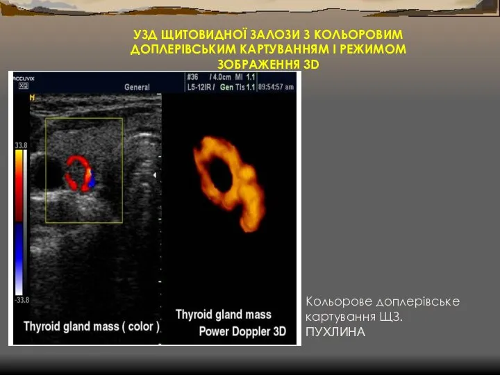 УЗД ЩИТОВИДНОЇ ЗАЛОЗИ З КОЛЬОРОВИМ ДОПЛЕРІВСЬКИМ КАРТУВАННЯМ І РЕЖИМОМ ЗОБРАЖЕННЯ 3D Кольорове доплерівське картування ЩЗ. ПУХЛИНА