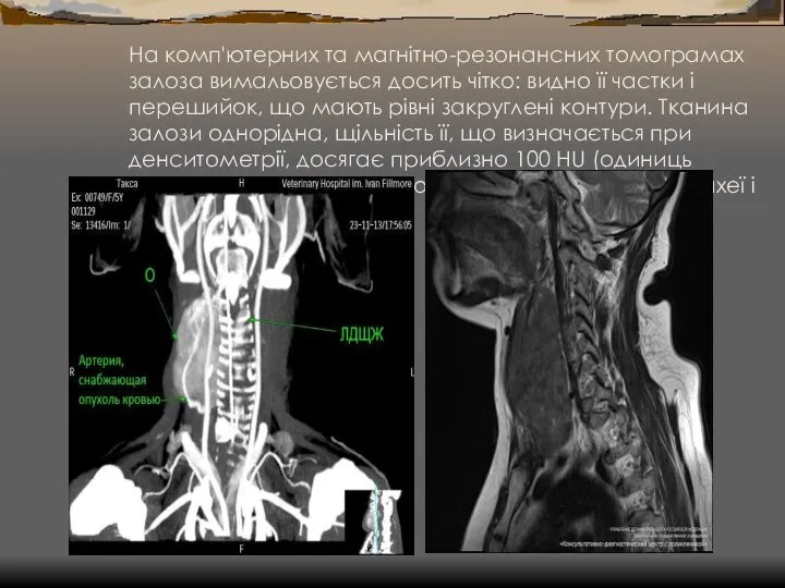 На комп'ютерних та магнітно-резонансних томограмах залоза вимальовується досить чітко: видно її