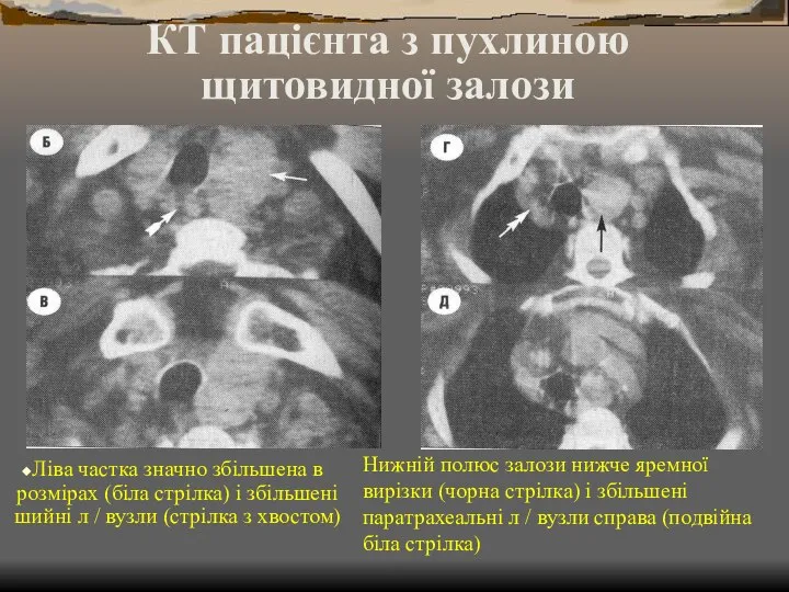 КТ пацієнта з пухлиною щитовидної залози Ліва частка значно збільшена в