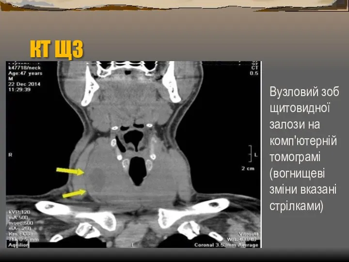 КТ ЩЗ Вузловий зоб щитовидної залози на комп'ютерній томограмі (вогнищеві зміни вказані стрілками)