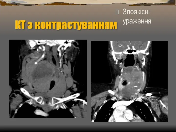 КТ з контрастуванням Злоякісні ураження