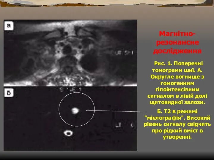 Магнітно-резонансне дослідження Рис. 1. Поперечні томограми шиї. А.Округле вогнище з гомогенним