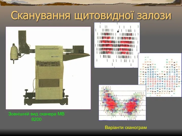 Сканування щитовидної залози Варіанти сканограм Зовнішній вид сканера МВ 8200