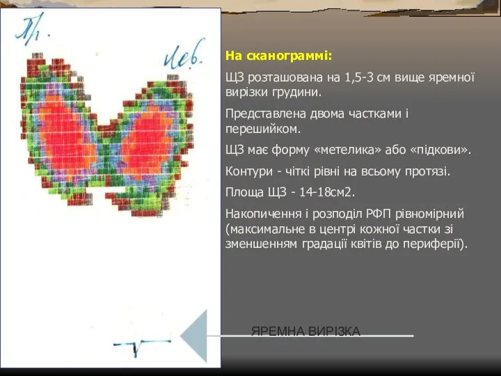 На сканограммі: ЩЗ розташована на 1,5-3 см вище яремної вирізки грудини.