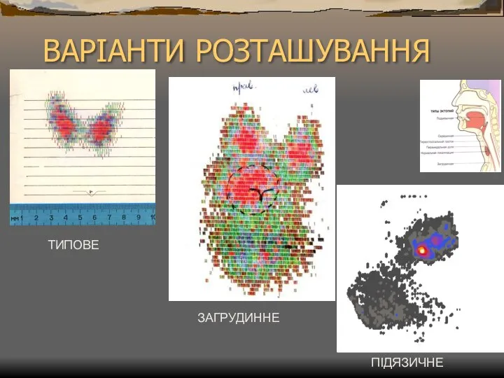 ВАРІАНТИ РОЗТАШУВАННЯ ТИПОВЕ ЗАГРУДИННЕ ПІДЯЗИЧНЕ