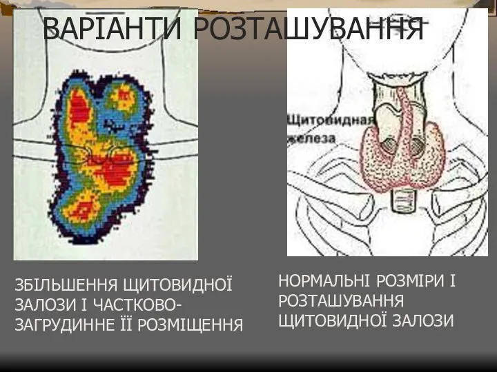 ЗБІЛЬШЕННЯ ЩИТОВИДНОЇ ЗАЛОЗИ І ЧАСТКОВО-ЗАГРУДИННЕ ЇЇ РОЗМІЩЕННЯ НОРМАЛЬНІ РОЗМІРИ І РОЗТАШУВАННЯ ЩИТОВИДНОЇ ЗАЛОЗИ ВАРІАНТИ РОЗТАШУВАННЯ