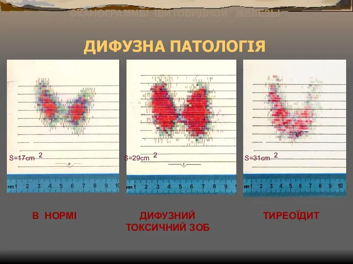 ДИФУЗНА ПАТОЛОГІЯ СКАНОГРАММЫ ЩИТОВИДНОЙ ЖЕЛЕЗЫ В НОРМІ ДИФУЗНИЙ ТОКСИЧНИЙ ЗОБ ТИРЕОЇДИТ