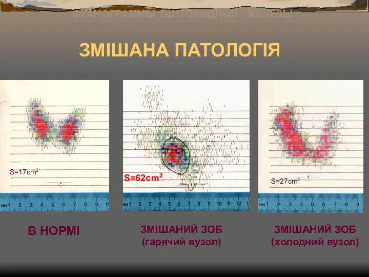 ЗМІШАНА ПАТОЛОГІЯ В НОРМІ ЗМІШАНИЙ ЗОБ (гарячий вузол) ЗМІШАНИЙ ЗОБ (холодний