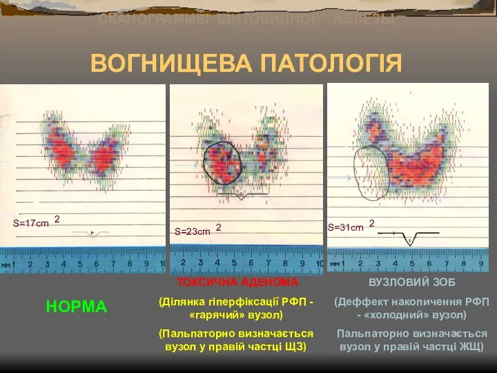 ВОГНИЩЕВА ПАТОЛОГІЯ НОРМА ТОКСИЧНА АДЕНОМА (Ділянка гіперфіксації РФП - «гарячий» вузол)