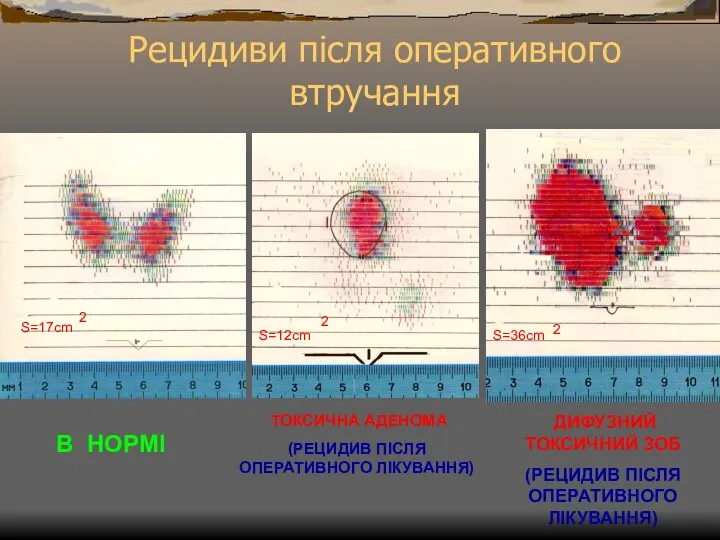 В НОРМІ ТОКСИЧНА АДЕНОМА (РЕЦИДИВ ПІСЛЯ ОПЕРАТИВНОГО ЛІКУВАННЯ) S=17cm 2 ДИФУЗНИЙ