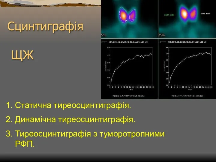 Сцинтиграфія ЩЖ 1. Статична тиреосцинтиграфія. 2. Динамічна тиреосцинтиграфія. 3. Тиреосцинтиграфія з туморотропними РФП.