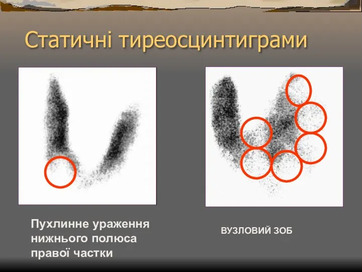 Статичні тиреосцинтиграми Пухлинне ураження нижнього полюса правої частки ВУЗЛОВИЙ ЗОБ