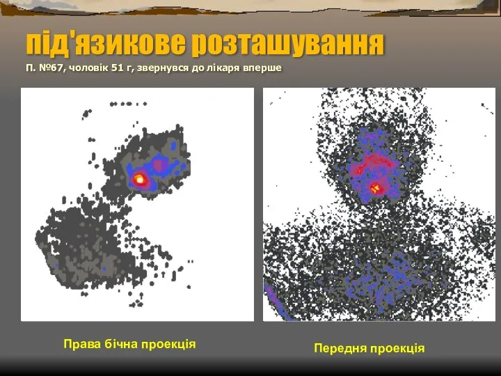 під'язикове розташування П. №67, чоловік 51 г, звернувся до лікаря вперше Права бічна проекція Передня проекція