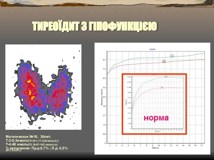 ТИРЕОЇДИТ З ГІПОФУНКЦІЄЮ Могилевская №16, 30лет. Т-3:0,3нмоль/л (N-1,17-2,8нмоль/л); Т-4:40 нмоль/л (N-67-142