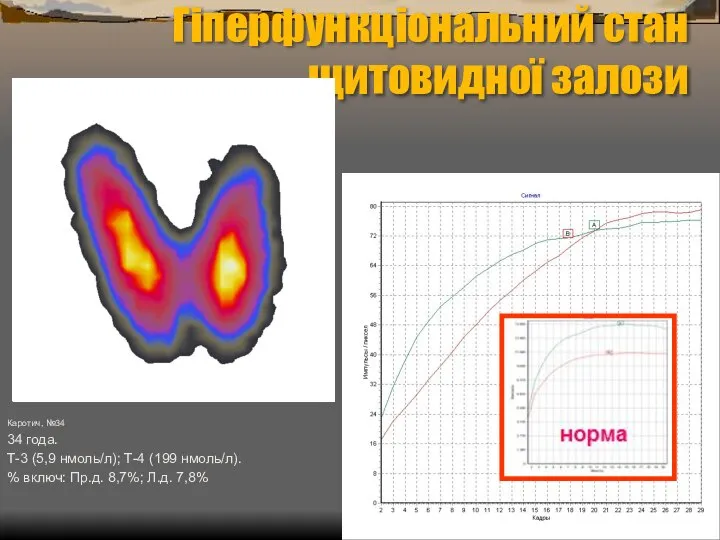 Гіперфункціональний стан щитовидної залози Каротич, №34 34 года. Т-3 (5,9 нмоль/л);