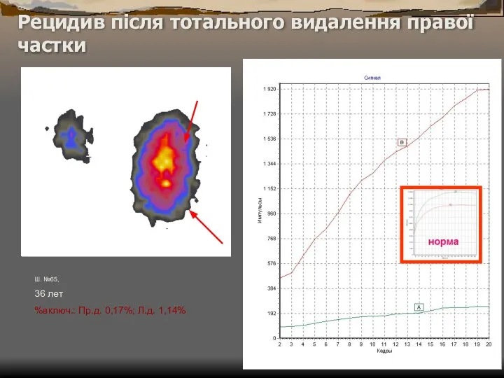 Рецидив після тотального видалення правої частки Ш. №65, 36 лет %включ.: Пр.д. 0,17%; Л.д. 1,14%