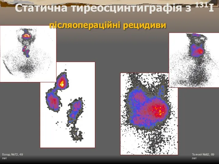 Голад №72, 49 лет Топчий №82, 69 лет Статична тиреосцинтиграфія з 131I післяопераційні рецидиви