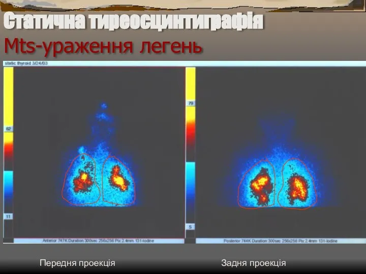 Статична тиреосцинтиграфія Mts-ураження легень Передня проекція Задня проекція