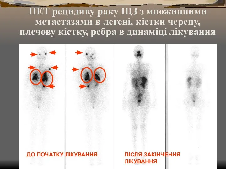 ПЕТ рецидиву раку ЩЗ з множинними метастазами в легені, кістки черепу,