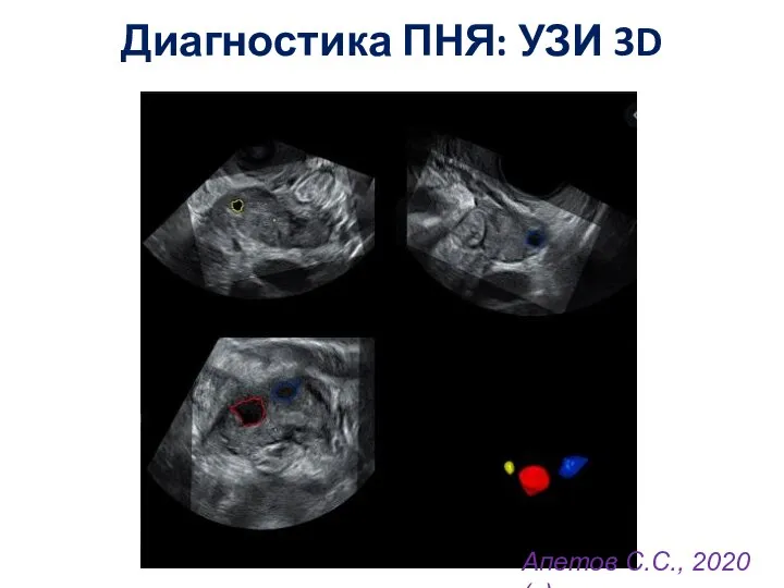 Диагностика ПНЯ: УЗИ 3D Апетов С.С., 2020 (с)