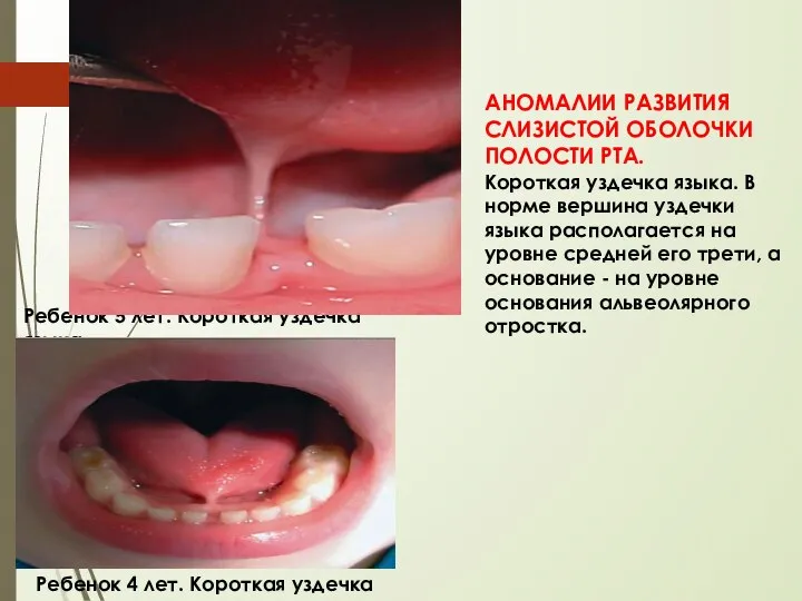 АНОМАЛИИ РАЗВИТИЯ СЛИЗИСТОЙ ОБОЛОЧКИ ПОЛОСТИ РТА. Короткая уздечка языка. В норме