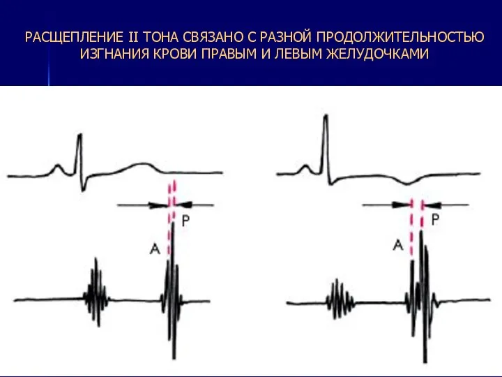 РАСЩЕПЛЕНИЕ II ТОНА СВЯЗАНО С РАЗНОЙ ПРОДОЛЖИТЕЛЬНОСТЬЮ ИЗГНАНИЯ КРОВИ ПРАВЫМ И ЛЕВЫМ ЖЕЛУДОЧКАМИ