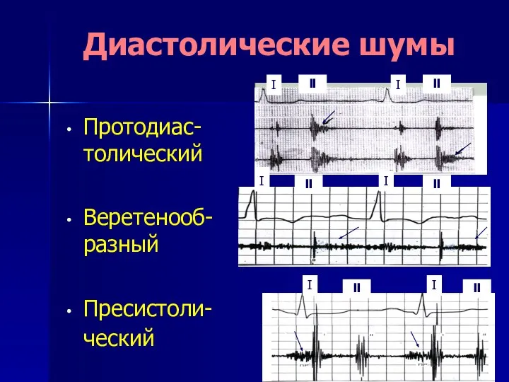 Диастолические шумы Протодиас- толический Веретенооб- разный Пресистоли- ческий I I I